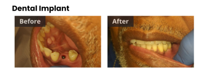dental implant before and after gretna