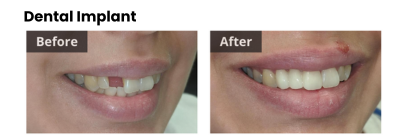 before and after dental implant photos gretna