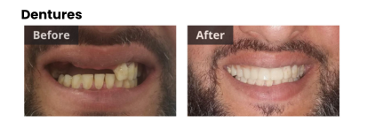 dentures before and after photos gretna