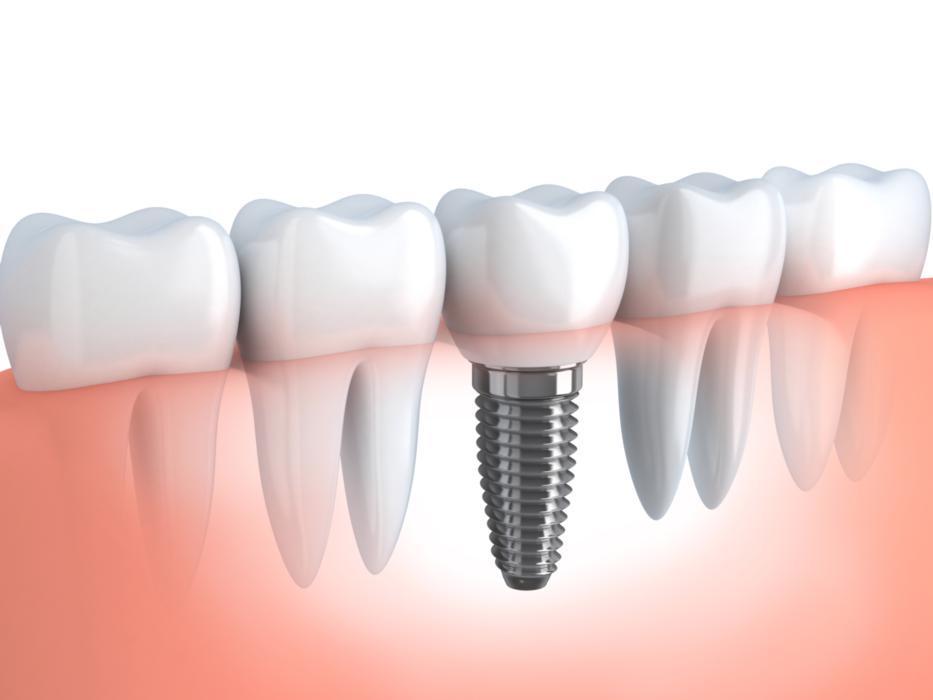 Dental implants in gretna LA