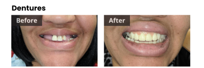 pictures of dentures before and after gretna 