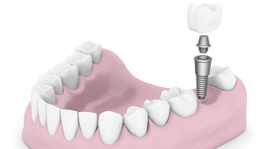 How Dental Implants Fit In Your Mouth Grenta LA Dentist