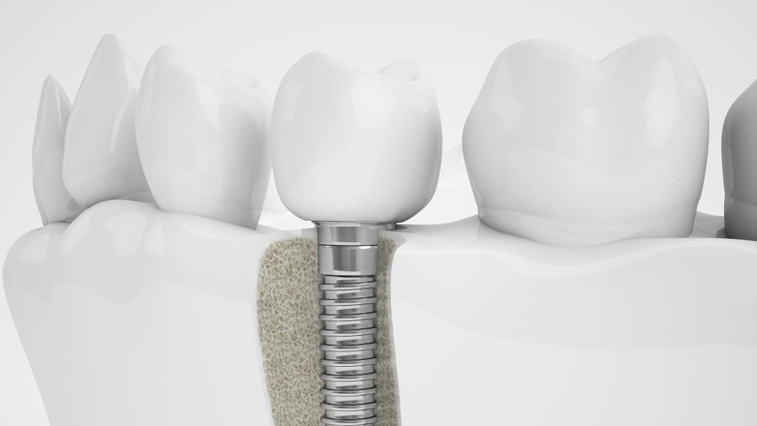 Dental Implants Gretna Implants and the bone around them.