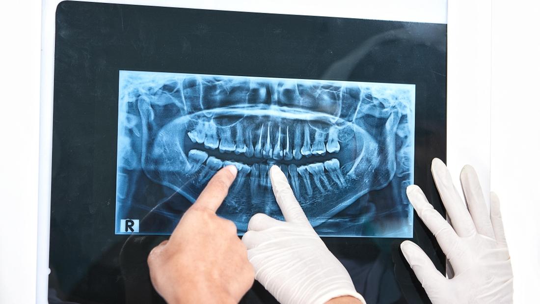 The Purpose of XRays Dentist in Gretna, LA Dr. Russell Schafer