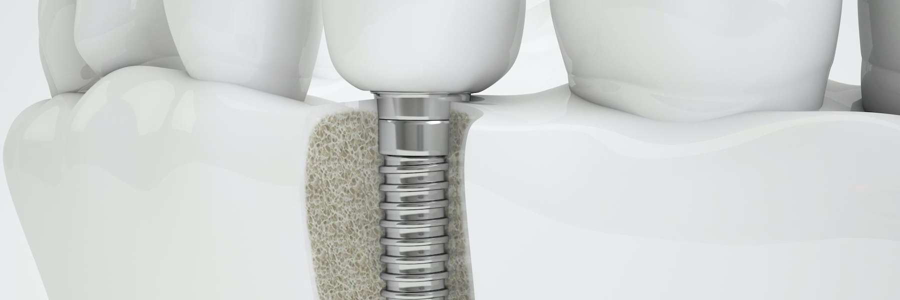 tooth replacement gretna | dental implant