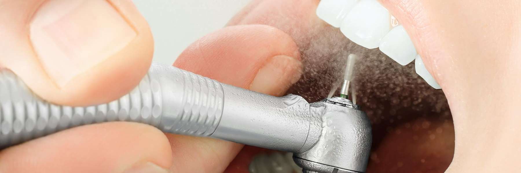 Dental fillings in Gretna, LA 70056