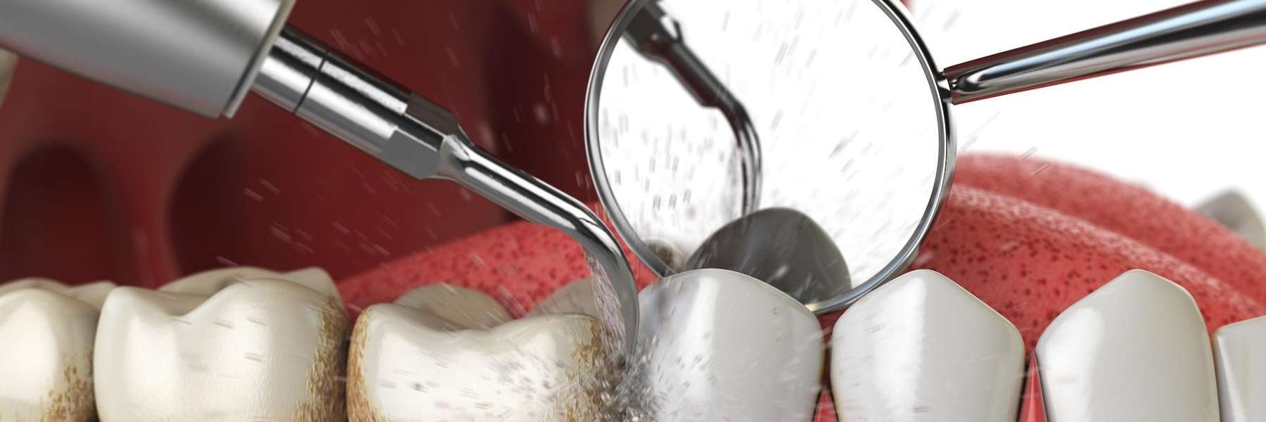 teeth cleaning gretna