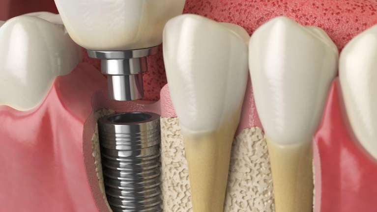 dental implants in gretna