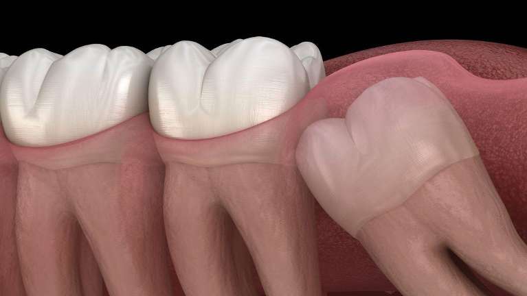 tooth extraction gretna | wisdom tooth removal