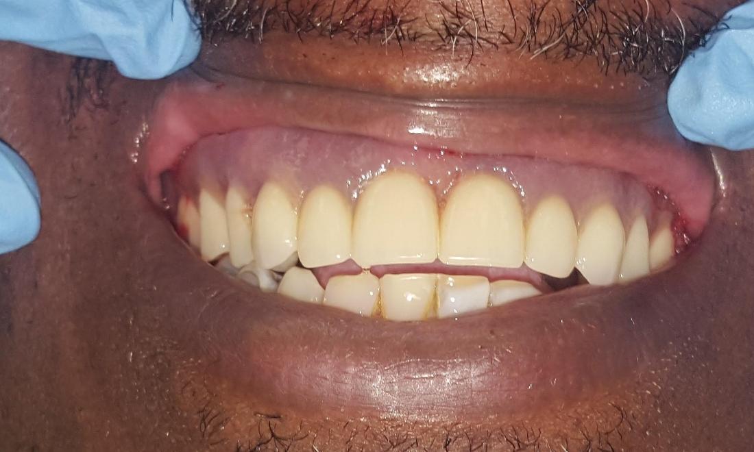 After Denture Repair