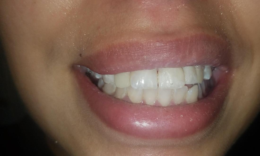 Patient with One Day Dentures | New Orleans