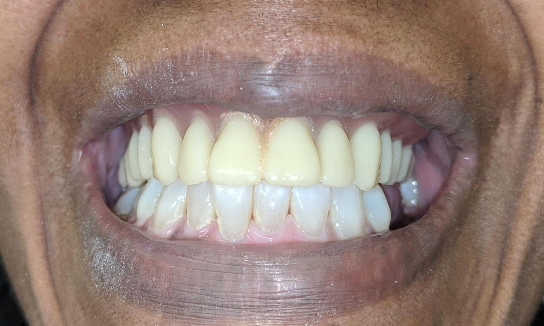 New Temporary Denture | NOLA Dentist