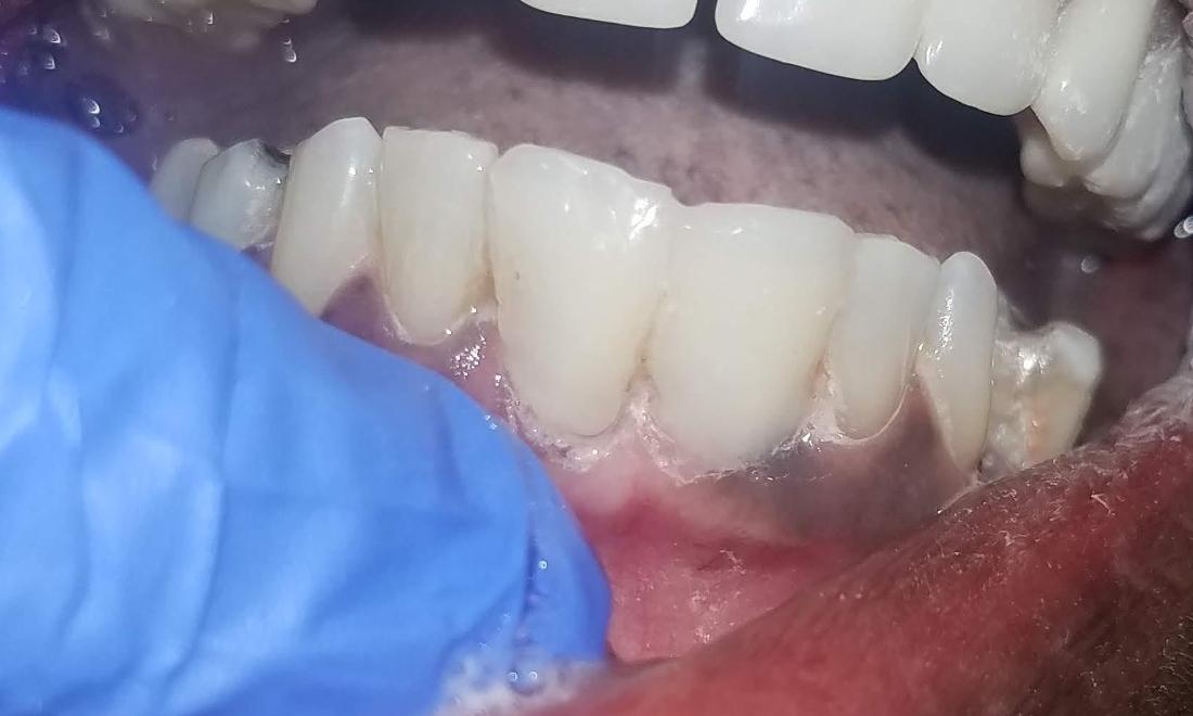 Patient with Fixed Gaps | Gretna LA