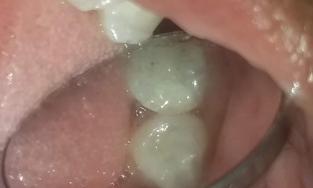 Fixed Broken Tooth | NOLA Dentist