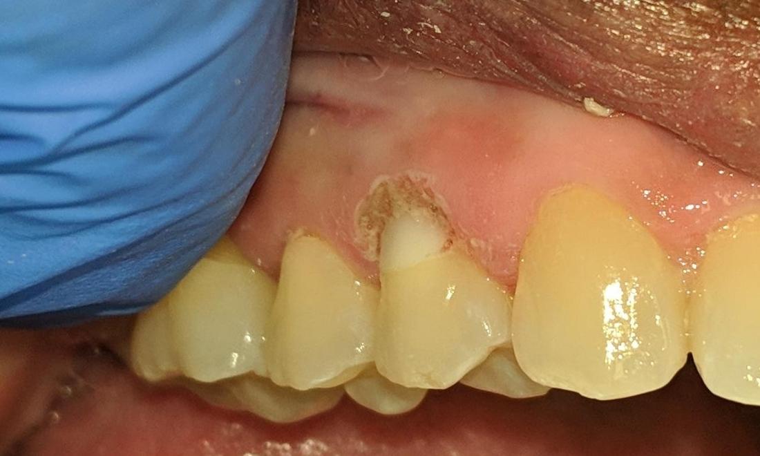 Fixed Cavity on Gum | Gretna LA Dentist