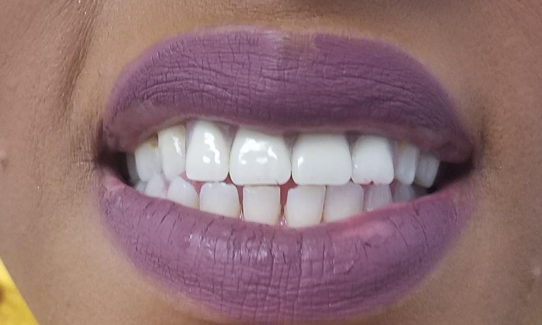 after image of smile makeover