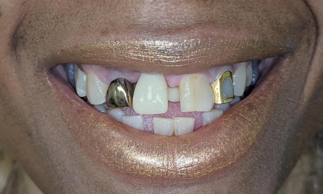 Replaced Front Tooth | New Orleans LA