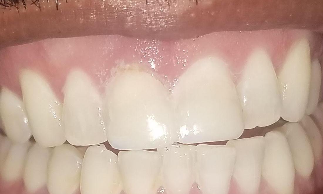 Chipped Tooth Fixed | Gretna LA Dentist