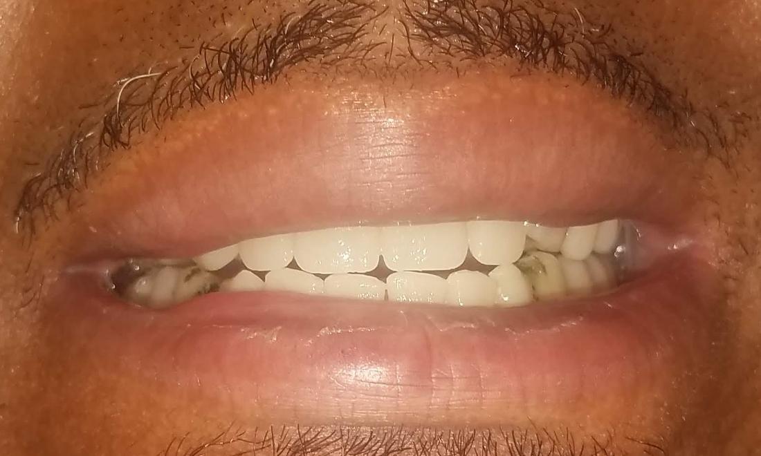 One Day Dentures Gretna LA