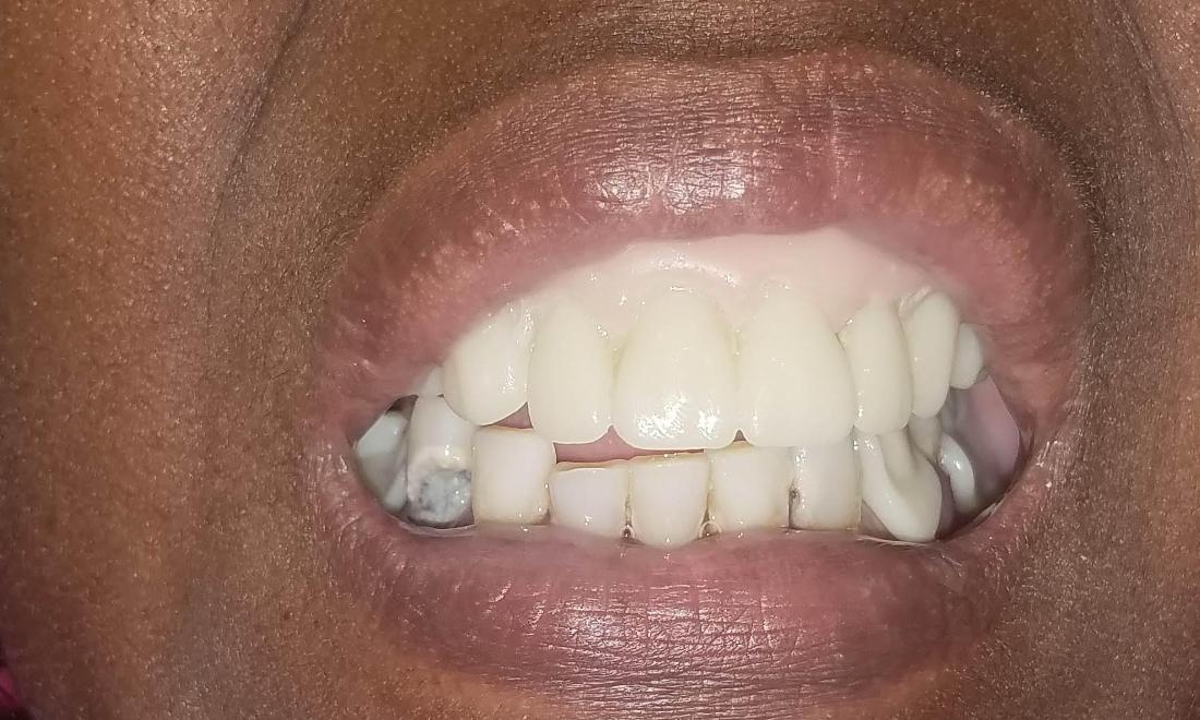 Patient After One Day Denture | Dr. Schafer