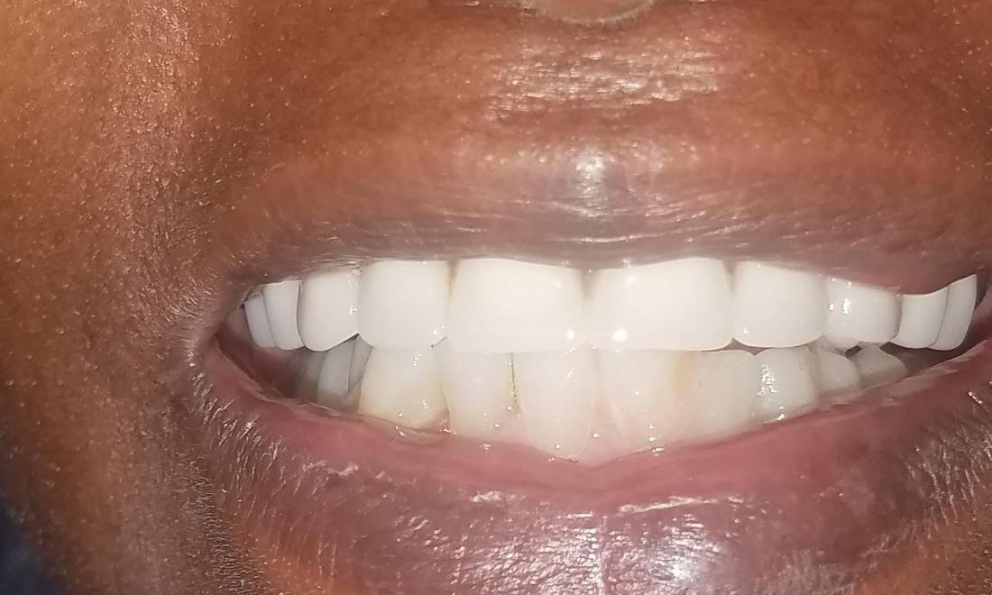 Patient After Dentures | Nola Dentist
