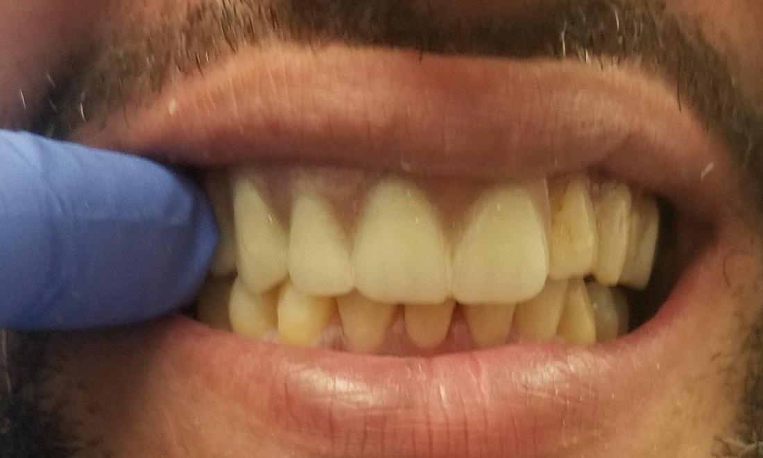 after image of dentures