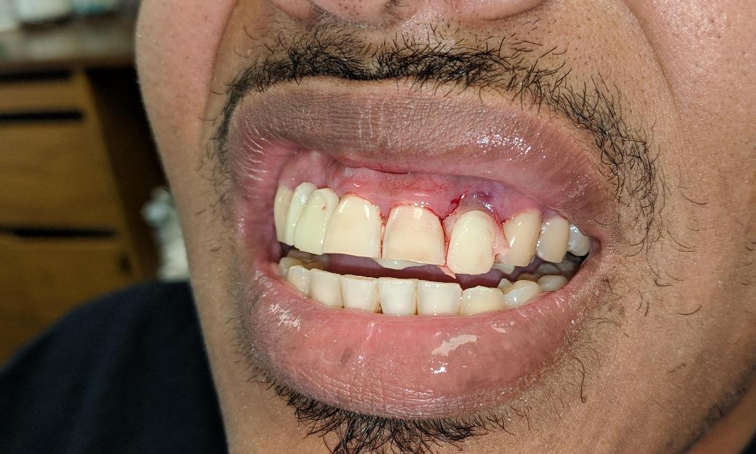 Replaced Missing Tooth | Dr. Russell Schafer