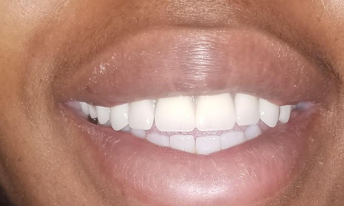 after photo of dentures