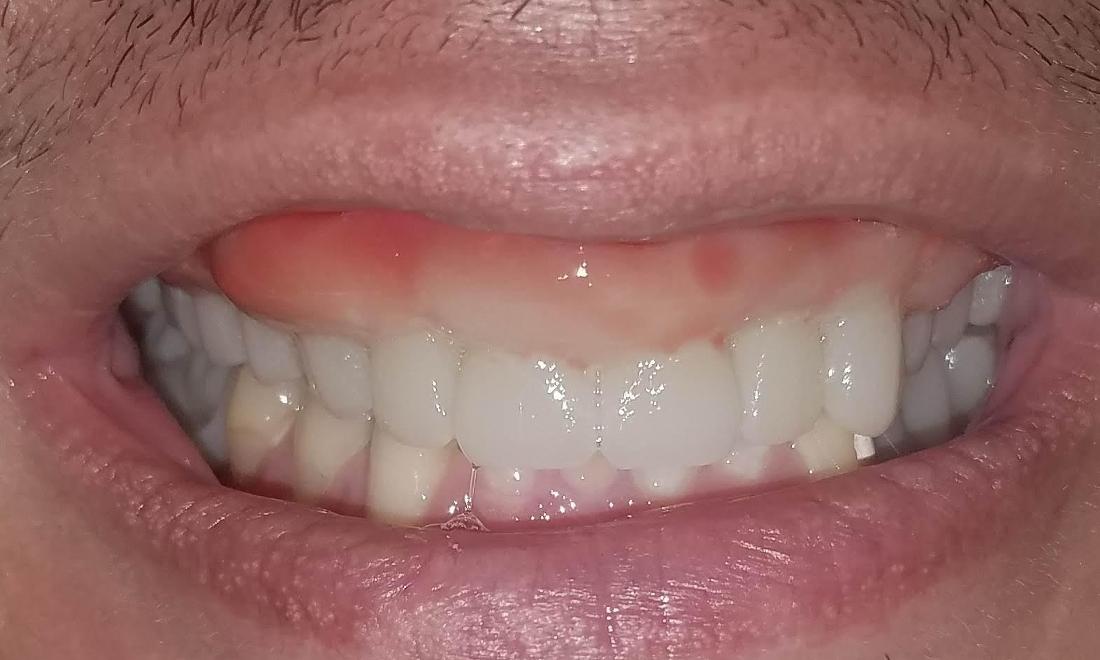 One Day Dentures | NOLA Dentist