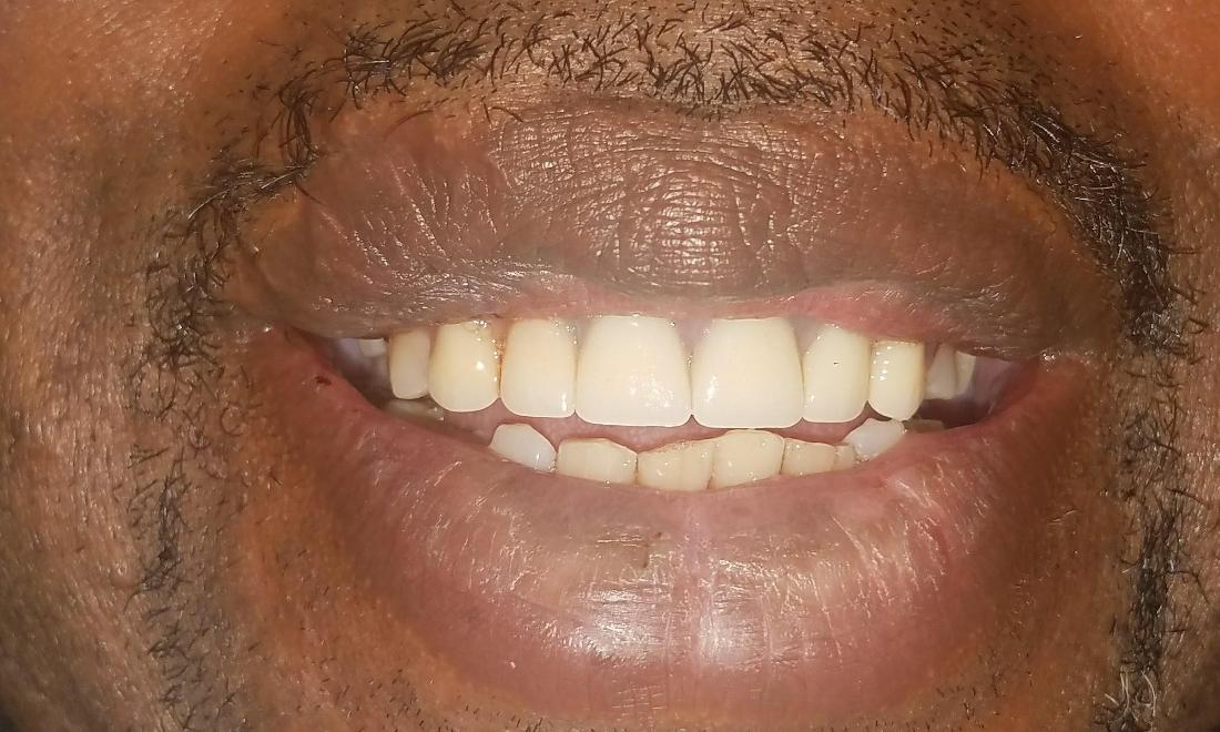 after smile makeover
