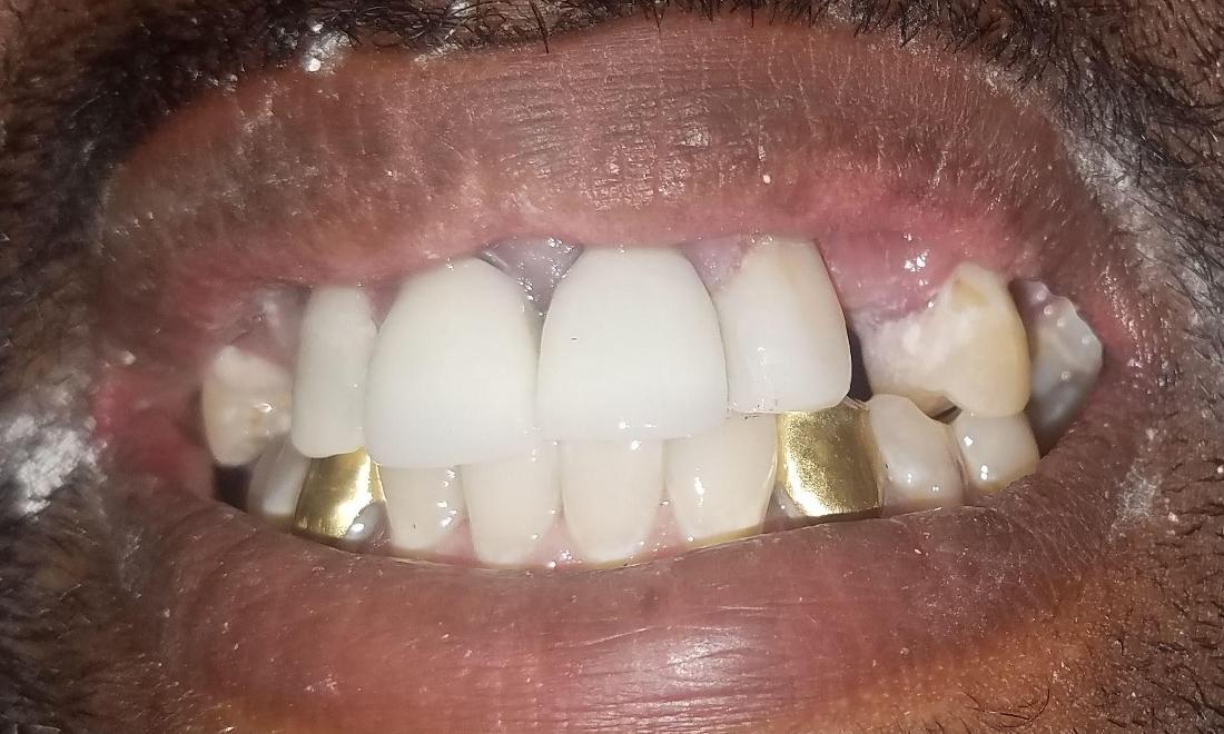 Patient After Removing Old Golds | NOLA