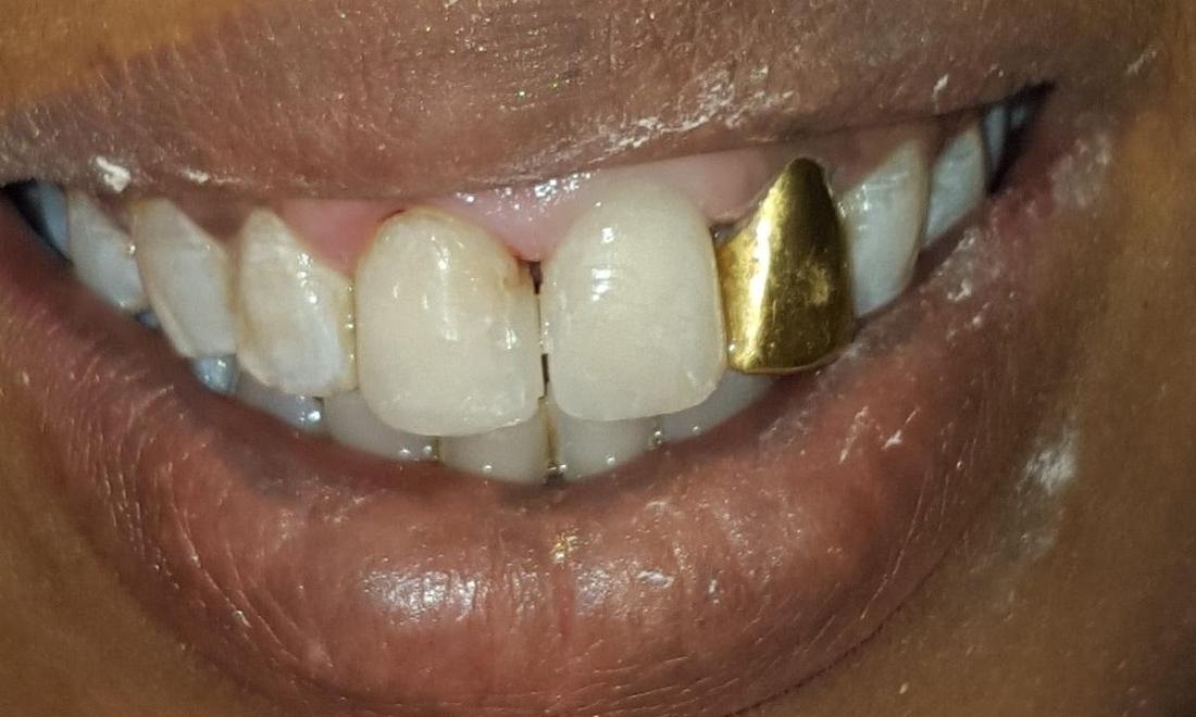 Gold Front Tooth Crown Gold Front Tooth Crown