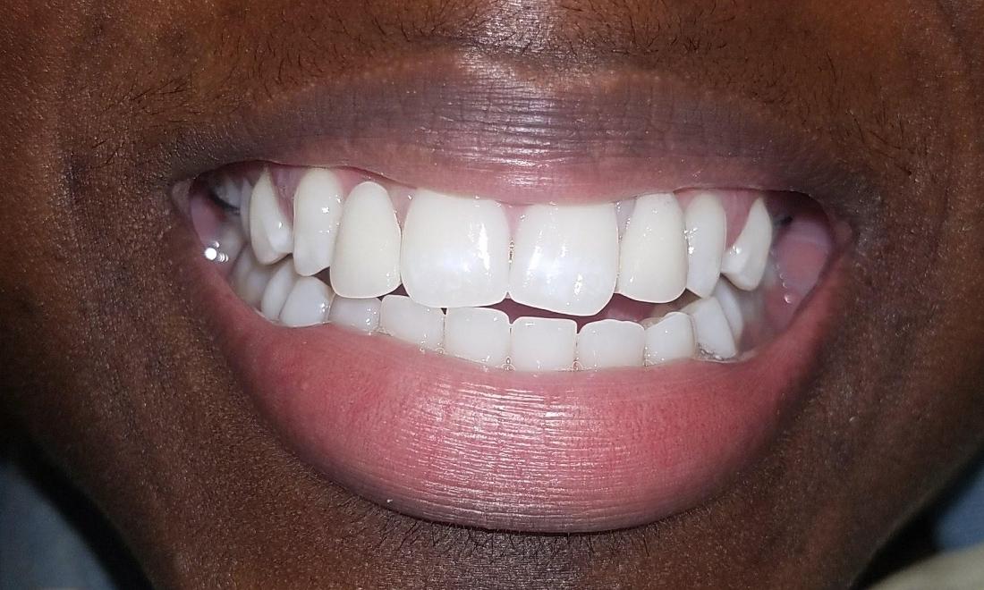 after image of replaced incisors