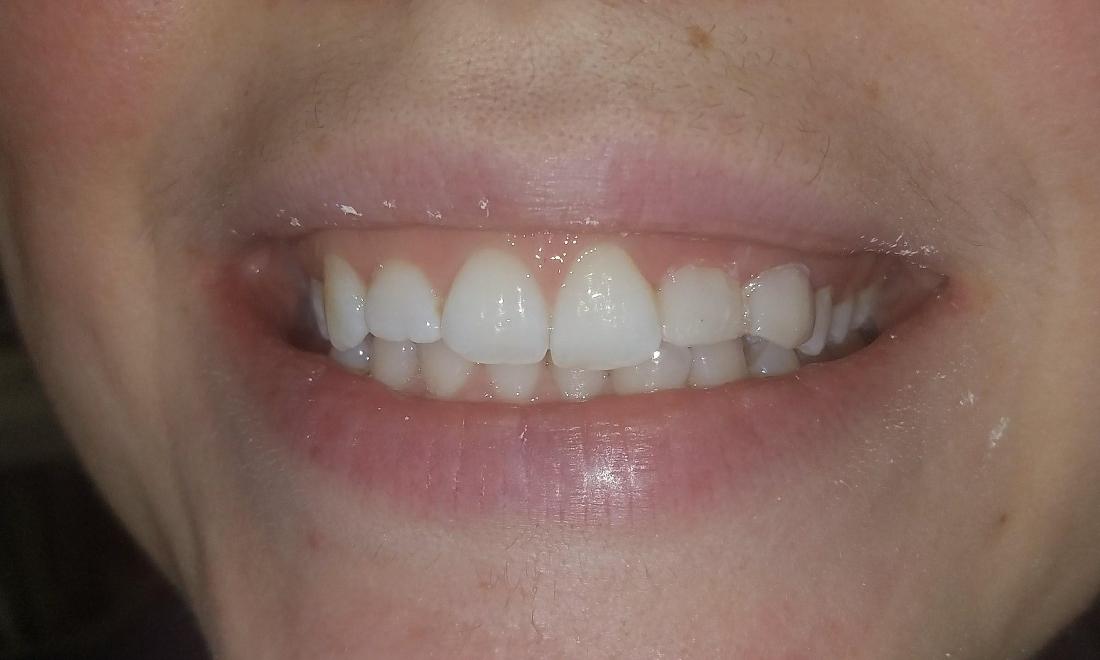 after photo of veneers