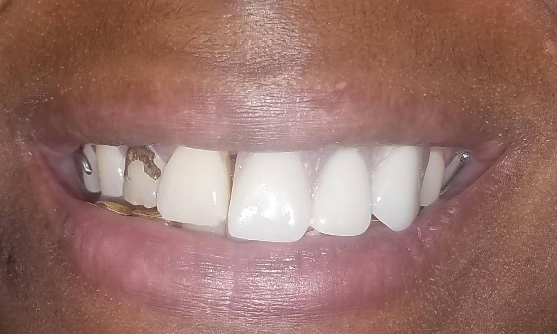 Restored Front Tooth New Orleans