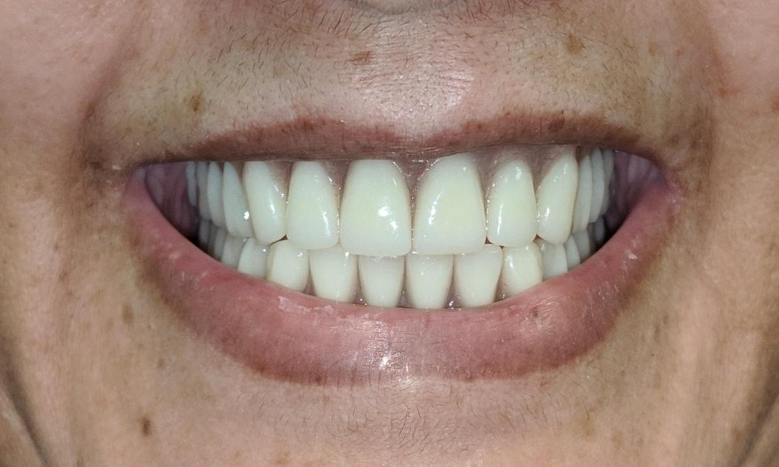 New Dentures | NOLA Dentures & General Dentistry