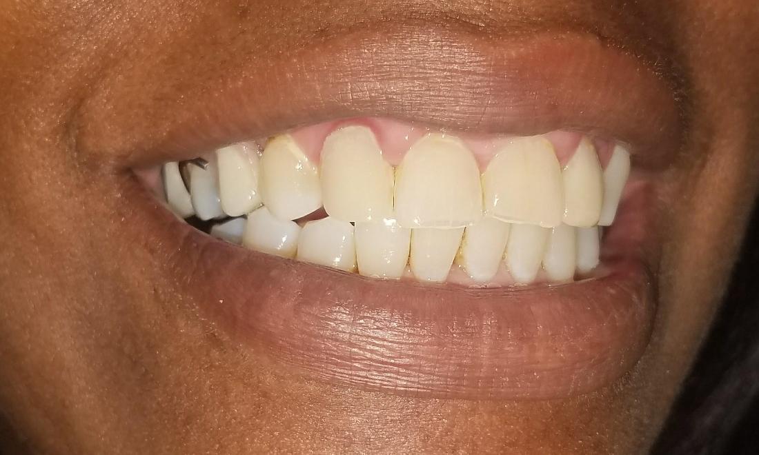 after photo of dentures