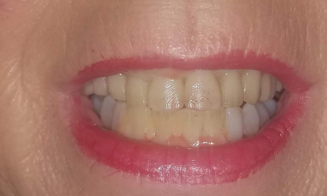 Six Month Smiles After | Dr. Russell Schafer