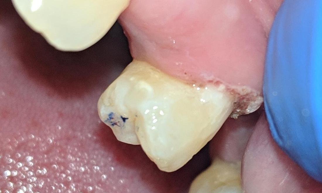 Fixed Fractured Tooth | New Orleans