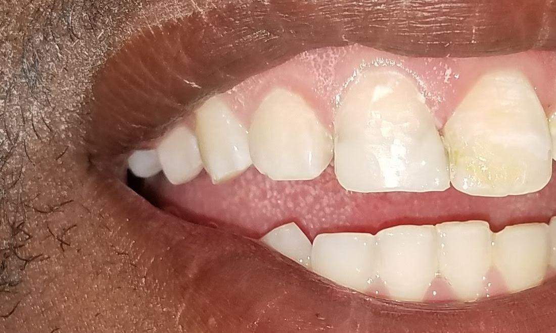 Repaired Front Tooth | Dr. Russell Schafer