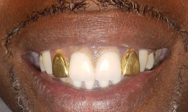 Gold Partial Dentures | Smile Gallery | Gretna LA