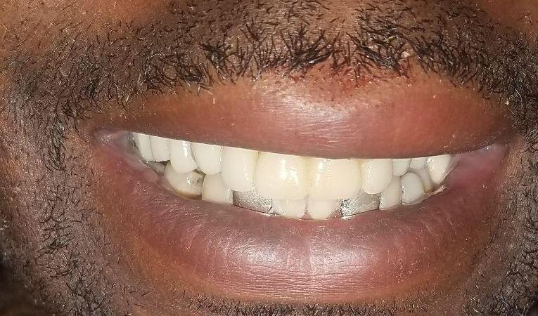 Same Day Denture | Dr. Russell Schafer