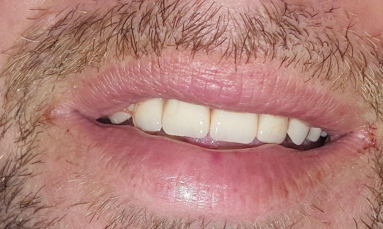After Dental Makeover | Dentist Gretna LA