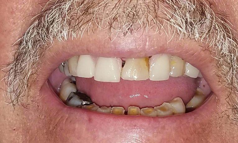 Strong partial denture for back teeth | Gretna LA Dentist