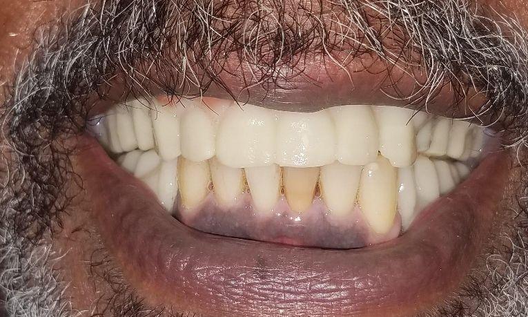 After One Day Dentures in Gretna LA