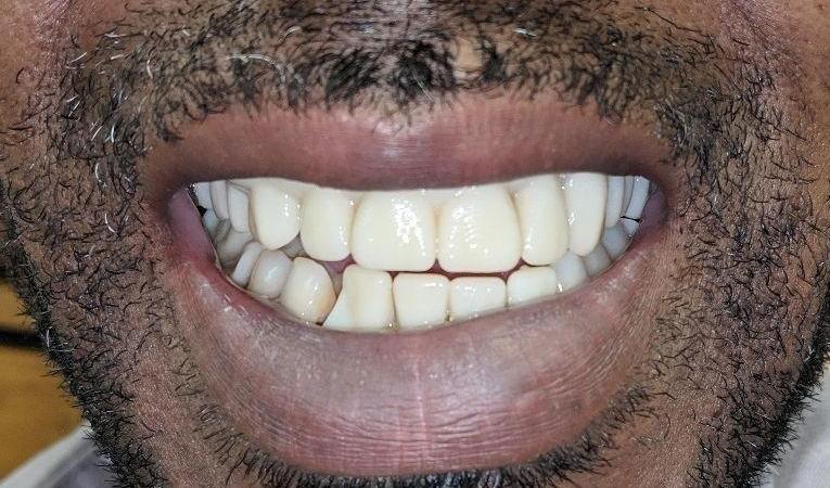 Patient after Dentures | Dr. Russell Schafer