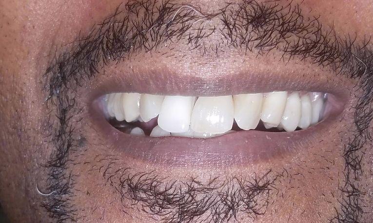 After front tooth partial | Gretna LA Dentist
