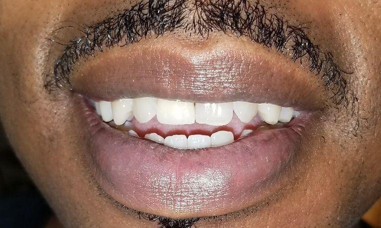 After new partial denture | Gretna LA Dentist