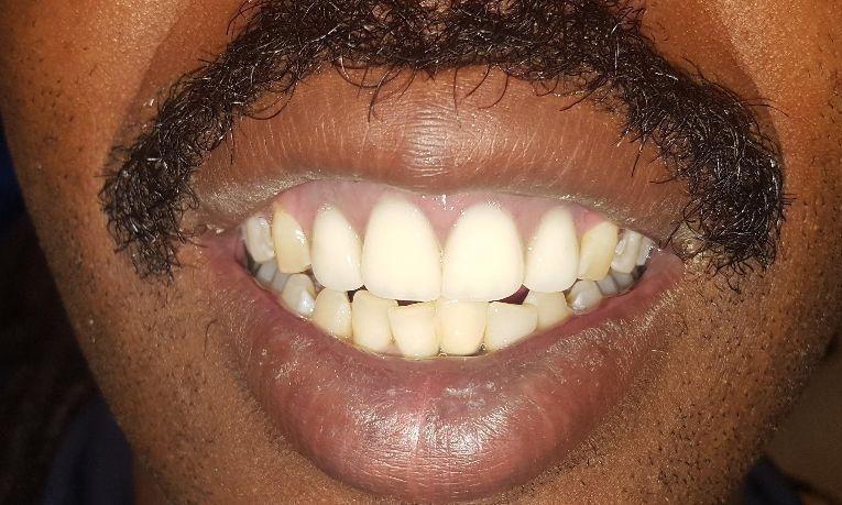 After replacing gold teeth | Gretna LA Dentist