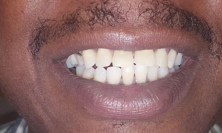 After partial denture to close gap